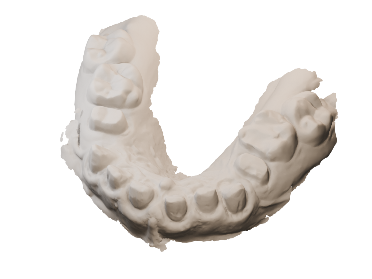Prepared upper dental scan with visible tooth preparations